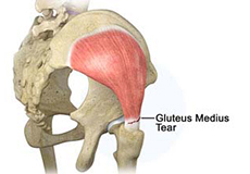 Gluteus Tendon Tear