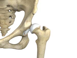 Hip Groin Disorders