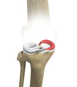 Medial Meniscus Syndrome