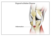 Osgood-Schlatter Disease