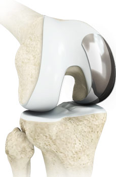 Unicompartmental / Partial Knee Replacement
